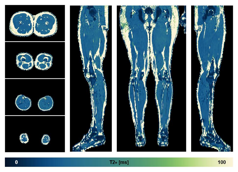 The T2 star relaxation time of the lower extremity obtained from the dixon reconstruction for muscle water fat quantification.